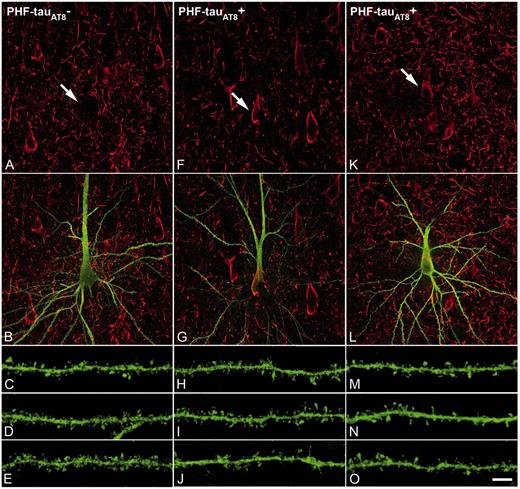 PHF-tau− and neurons with Pattern IIa PHF-tauAT8 staining. Neurons and dendrites in the CA1 of Patients P14 (A–J) and P13 (K–O), injected with Lucifer yellow, and with a soma free of PHF-tauAT8 (; A–E) or with PHF-tauAT8–ir tangles (Pattern IIa; F–O). (A–B, F–G and K–L) Stacks of 18 and 35 images, respectively, obtained after combining the channels acquired separately for Lucifer yellow (green) and PHF-tauAT8 (red). (C–D, H–J and M–O) Stacks of 26–58 optical confocal sections of the basal dendrites of  (A and B) and immunostained (; F–G, K–L) Lucifer yellow-injected pyramidal neurons. These  and  Lucifer yellow-injected neurons were recovered and reprocessed immunocytochemically using anti-PHF-tauPHF-1. The  neuron was non-immunostained for PHF-tauPHF-1 (PHF-tau−), whereas the  neurons were also PHF-tauPHF-1 (Supplementary Fig. 5). Scale bars: A, F and K = 10 µm; C–E, H–J and M–O = 3 µm.
