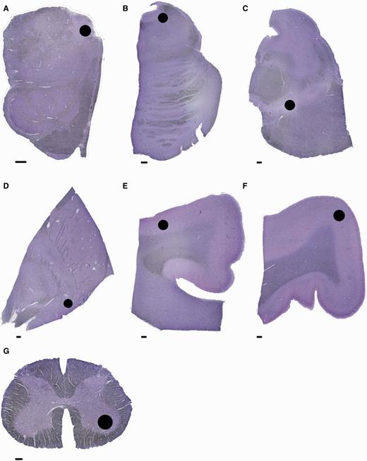 Anatomical regions examined. Sections stained with Cresyl violet showing the areas (black circle) where cell count and optical density measurements were taken. (A) Medulla with dorsal motor nucleus of the vagus nerve; (B) pons with locus coeruleus; (C) midbrain with substantia nigra pars compacta; (D) basal forebrain with nucleus basalis of Meynert; (E) cingulate gyrus with grey matter of superior sulcus (cingulate cortex); (F) precentral gyrus grey matter (primary motor cortex); (G) lumbar spinal cord with ventral horn. Scale bar = 1 mm.