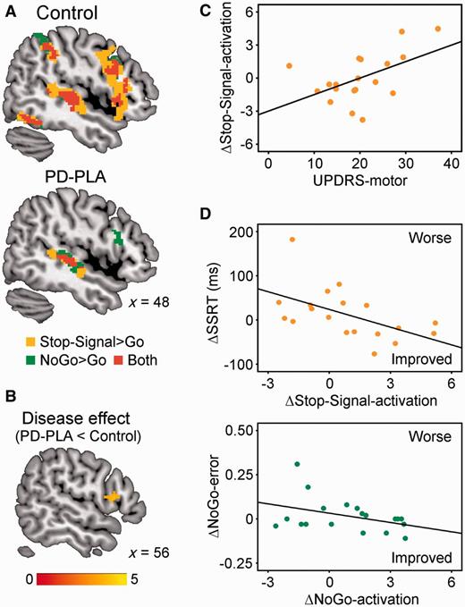 (A) In functional MRI, controls showed greater stop-related (Stop-Signal > Go, orange) and NoGo-related activations (NoGo > Go, green) in the right inferior frontal gyrus (P < 0.05 corrected). Activation overlap is in red. Coordinates are in MNI space. (B) The stop-related right inferior frontal gyrus activation was significantly weaker in Parkinson’s disease-placebo (PD-PLA) than in controls (disease effect, P < 0.05 corrected). Colour scale indicates t-values. (C) Citalopram’s enhancement of right inferior frontal gyrus activation in successful stops positively correlated with UPDRS-motor score (P < 0.05). (D) The drug-induced changes of SSRT (ΔSSRT) and NoGo-error (ΔNoGo-error) respectively related to right inferior frontal gyrus activation changes in successful Stop-Signal trials (ΔStop-Signal-activation) and those in NoGo trials (ΔNoGo-activation).