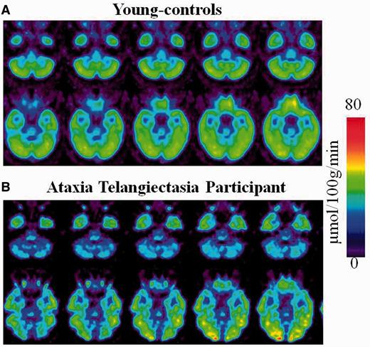 Regional brain metabolic images of healthy controls and of a participant with ataxia-telangiectasia. (A) Averaged brain images of younger-controls showing sequential axial planes at the levels where the cerebellum and the fusiform gyrus are located. (B) Brain images from a participant with ataxia-telangiectasia showing the same axial planes as for the averaged images of the younger-controls.