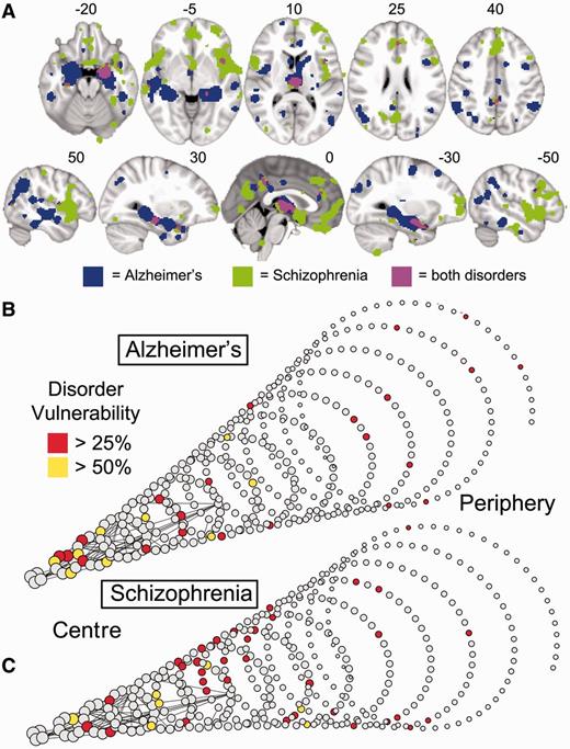 Schizophrenia and Alzheimer’s disease impact mainly on anatomically distinct subsets of hubs. (A) Meta-analytic maps of cortical and subcortical lesions associated with schizophrenia (green voxels), or Alzheimer’s disease (blue voxels), or both disorders (pink voxels). (B and C) Lesions mapped in spiral networks in schizophrenia (B) and Alzheimer’s disease (C) where the tip represents the highest degree nodes for both disorders and the strongest 0.1% of edges are shown.