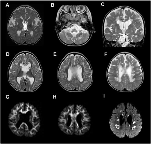 Brain abnormalities in patients harbouring LRPPRC mutations identified by cranial magnetic resonance imaging. (A) Axial T2 demonstrating symmetrical T2 hyperintensity in the putamina (Patient 8). (B) Axial T2 demonstrating symmetrical medullary and cerebellar hyperintensity (Patient 8). (C) Coronal T2 demonstrating symmetrical putaminal and periventricular T2 hyperintensity (Patient 10). Appearances in A–C are consistent with Leigh syndrome phenotype. (D–F) Axial T2 images of the brain with corresponding diffusion-weighted imaging sequences (G–I) demonstrating active demyelinating leucoencephalopathy involving the subcortical U-fibres, basal ganglia and corpus callosum in D, E, G and H (Patient 2) and cystic demyelination in the deep white matter in F and I (Patient 8).