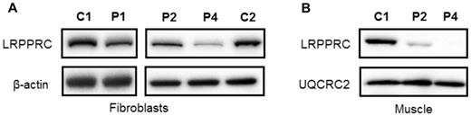 Steady-state LRPPRC protein levels are reduced in LRPPRC patient tissues. Western blot analysis of LRPPRC levels in protein extracts isolated from (A) fibroblasts and (B) skeletal muscle of control (C1, C2), homozygous LRPPRC (Patients 1 and 2; P1, P2) and compound heterozygous (Patient 4, P4) LRPPRC patients. In (A) β-actin and in (B) UQCRC2 antibodies were used as loading controls.