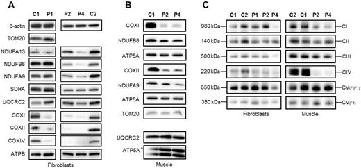Steady-state levels of OXPHOS components and complexes. Western blot analysis of subunits of the respiratory chain complexes in (A) cell lysates of fibroblasts and (B) mitochondrial extracts of muscle isolated from control (C1, C2), homozygous LRPPRC (Patient 1, P1; Patient 2, P2) and compound heterozygous LRPPRC (Patient 4, P4) patient samples. Subunit-specific antibodies were used against CI (NDUFA13, NDUFA9, NDUFB8), CII (SDHA), CIII (UQCRC2), CIV (COXI, COXII, COXIV) and CV (ATP5A, ATPB). (A and B) LRPPRC patient fibroblasts and muscle show an almost complete loss of respiratory chain subunits from Complex IV, as well as significant loss of some subunits from Complex I. Complex III showed a mild loss of subunit UQCRC2 in Patient 4 fibroblasts, while Complex V showed no loss of protein in either patient fibroblasts or muscle samples. The nucleus-encoded Complex II (SDHA), cytosolic β-actin and the outer mitochondrial membrane marker TOM20 were used as loading controls. (C) Mitochondrial proteins from fibroblasts and skeletal muscle samples of control (C1, C2) and homozygous LRPPRC (Patients 1 and 2) and compound heterozygous LRPPRC (Patient 4) patients were extracted in DDM and analysed by one-dimensional Blue Native PAGE. Subunit-specific antibodies [CI (NDUFA9), CII (SDHA), CIII (UQCRC2), CIV (COX1) and CV (ATP5A)] were used to assess the assembly of individual OXPHOS complexes. Immunoblot analysis revealed decreased amounts of fully assembled Complex IV in patient fibroblasts and muscle compared to age-matched controls. A decrease in Complex I assembly was observed in LRPPRC patients muscle (Patients 2 and 4) and compound heterozygous fibroblasts (Patient 4). Complex II (SDHA) was used as a loading control.