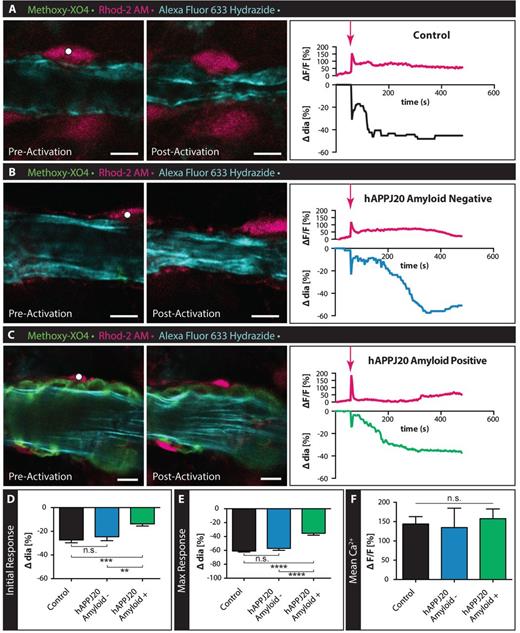 Response of vessels covered by vascular amyloid are impaired in hAPPJ20 mice. (A–C) Confocal images of arterioles in acute slices labelled with Alexa Fluor® 633 Hydrazide (cyan) and methoxy-XO4 to label vascular amyloid (green) before and after Calcium (Ca2+) uncaging in 27–29-month-old animals. Astrocytes were loaded with the Ca2+ indicator Rhod-2 AM (magenta) and caged Ca2+ DMNPE-4. Ca2+ uncaging in an astrocyte end-foot or cell body (white dot indicates area of uncaging) close to an arteriole leads to constriction of this vessel in response to the large increase in intracellular Ca2+. Traces depict changes in intracellular Ca2+ and changes in vessel diameters over time. Magenta arrows indicate when uncaging occurred. While vessels in control slices (A) and slices from hAPPJ20 mice without vascular amyloid (B) respond with strong initial and maximal constrictions, vessels from hAPPJ20 slices that are covered by vascular amyloid show a reduced response (C). Scale bar = 10 µm. (D and E) Quantification of initial and maximal vessel constrictions show significantly reduced responses in hAPPJ20 only if vascular amyloid was covering the vascular wall. (F) Mean Ca2+ ΔF/F between groups shows no significant difference. Statistical data in D: Initial response, control, n = 25 vessels from four animals; hAPPJ20 Amyloid−, n = 17 vessels from three animals, hAPPJ20 Amyloid+, n = 24 vessels from four animals, One-way ANOVA with Holm-Sidak’s multiple comparisons test, P = 0.0002. (E) Maximal response, control, n = 26 vessels from four animals; hAPPJ20 Amyloid–, n = 18 vessels from three animals, hAPPJ20 Amyloid+, n = 26 vessels from four animals, One-way ANOVA with Holm-Sidak’s multiple comparisons test, P < 0.0001. Error bars on bar graphs reflect SEM. Statistical significance: *P-value < 0.05, **P < 0.01, ***P < 0.001, ****P < 0.0001.
