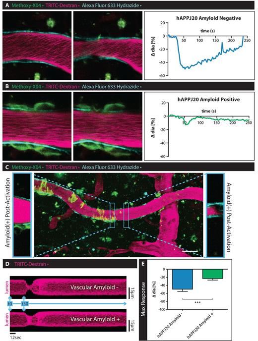 Vascular smooth muscle cell function is impaired in hAPPJ20 mice in vivo. To assess VSMC function in vivo, hAPPJ20 mice were injected with methoxy-XO4 (green) to label vascular amyloid, TRITC-Dextran (magenta) to outline the vascular lumen and Alexa Fluor® 633 Hydrazide (cyan) to identify arterioles and imaged through a cranial window using multi-photon microscopy at 30 months of age. Vessels with and without vascular amyloid were chosen for time-lapse imaging before and after laser-stimulation of VSMCs (white dot indicates area of stimulation). (A) Laser-stimulation of VSMCs associated with vessels without vascular amyloid consistently induced vasoconstrictions. (B) This response was impaired in vessels covered by vascular amyloid. Scale bar = 10 µm. (C) Vessels sometimes had certain areas covered by vascular amyloid while other areas were devoid of amyloid. Laser-stimulation of these same vessels showed a reduction in response only in the areas affected by vascular amyloid. Insets show two neighbouring areas of the same vessel after laser-stimulation. While the area free of vascular amyloid constricts normally, the neighbouring part of the vessel that is surrounded by vascular amyloid responds to a lesser degree. Scale bar = 30 µm. (D) Image analysis over time (representative of a line scan) shows the diminished response of the vessel area covered by amyloid (lower panel) compared to the unaffected vessel region (upper panel). Measured sections were 1.88-µm wide taken at a frame interval of 3 s. (E) Quantitation of change in vessel diameter after laser-stimulation of VSMCs in vivo. hAPPJ20 Amyloid−, n = 11 vessels from three animal versus hAPPJ20 Amyloid+, n = 11 vessels from three animals, unpaired t-test, one-sided, ***P = 0.0004. Sidak’s multiple comparisons test, P = 0.4541).