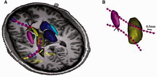 Selection procedure selection of neuronal tracts. (A) Selection of cortico-striatal and thalamo-cortical tracts. A tract was considered to intersect a nucleus (striatum or thalamus) if at least three tract points were inside the nucleus. For the cortex, only intersections with <2 mm from the low band of cortical area were considered. (B) Selection of tracts among basal ganglia structures and thalamus. A tract was considered for the analysis, if it intersected the nucleus at least on the three points. Black crosses represent the tracts that were rejected.