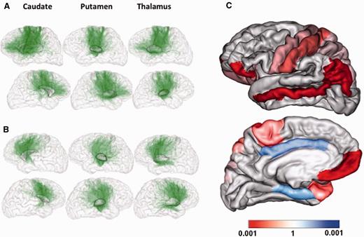 Cortico-striatal and thalamo-striatal tracts. (A and B) Individual level: (A) GTS patient, (B) healthy control. The top row represents the right hemisphere and the bottom row the left hemisphere. (C) Differences on group level analysis: in red are the cortical areas with enhanced structural connectivity in patients with GTS compared to controls; in blue are the cortical areas with diminished structural connectivity in patients with GTS compared to controls. The differences in structural connectivity of both hemispheres are projected to the cortical areas of the left hemisphere.