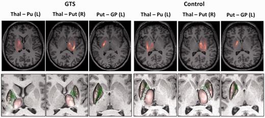 Individual thalamo-strital and striato-pallidal connections in patients with GTS and controls. Top row: The density of connections map on individual level; Bottom row: Thalamo-striatal and striato-pallidal connections on individual level. Only connections with statistically significant difference in structural connectivity on group level are illustrated. L = left; R = right; Thal-Pu(t) = thalamo-putaminal connections; Put-GP = putamen-globus pallidus connections.