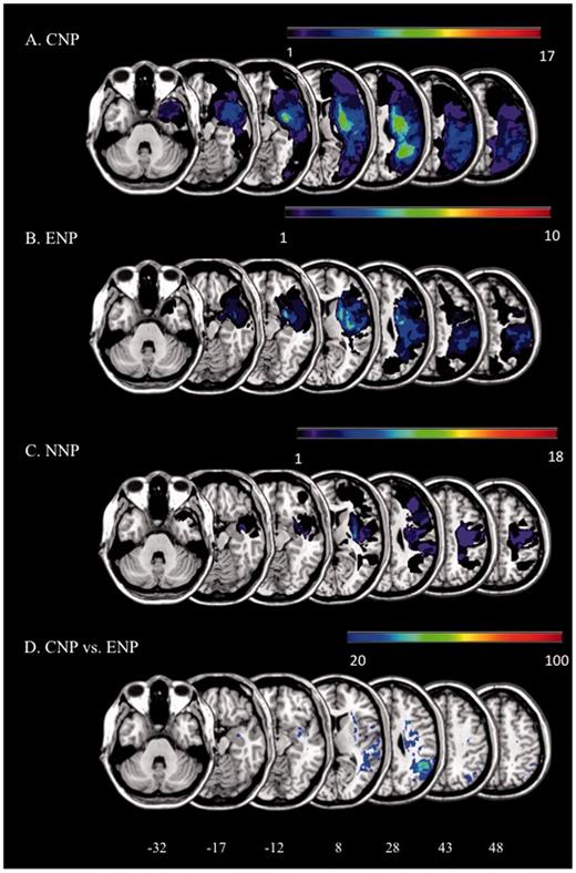 Lesion overlap. (A–C) Overlap of the lesions for all the included right brain-damaged patients. (D) Results of the subtraction of the probability map of the ex-neglect group from the probability map of the chronic neglect group. Only areas that were damaged 20% more frequently in chronic neglect patients than in ex-neglect patients are reported in the figure. NNP = non-neglect patients.