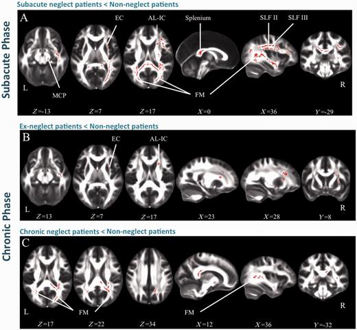 Results of TBSS. FA differences (P = 0.025) are represented in red. (A) contrast subacute neglect < non-neglect patients; (B) contrast recovered neglect < non-neglect patients; (C) contrast chronic neglect < non-neglect patients. SCP = superior cerebral peduncle; FM = forceps major; SLF = superior longitudinal fasciculus; EC = external capsule; AL-IC = anterior limb of the internal capsule.