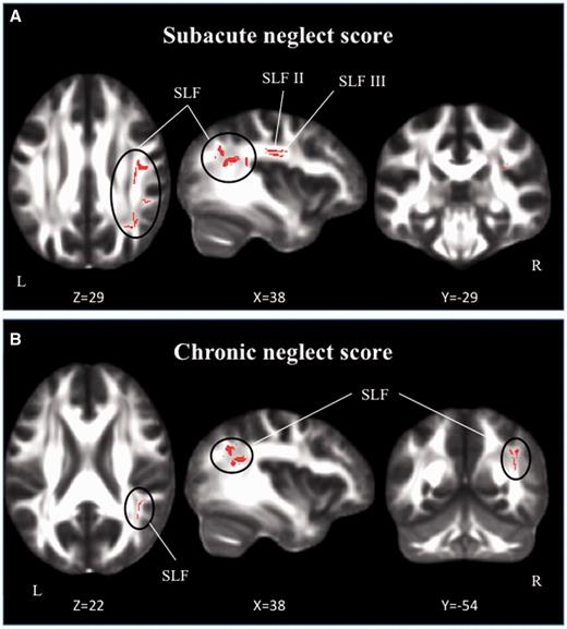 Relationship between white matter damage and severity of neglect. (A) Subacute phase; (B) chronic phase. Results of TBSS regression analyses are represented in red (P = 0.025), corrected for multiple comparisons.