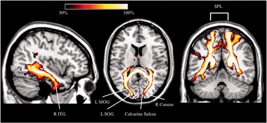 Results of TBSS. Percentage map in healthy subjects (n = 40) showing the cortical projections of the splenial voxels (forceps major) identified by TBSS analysis in chronic neglect patients compared to non-neglect patients. L = left; MOG = middle occipital gyrus; R = right; SOG = superior occipital gyrus; SPL = superior parietal lobule; ITG = inferior temporal gyrus.