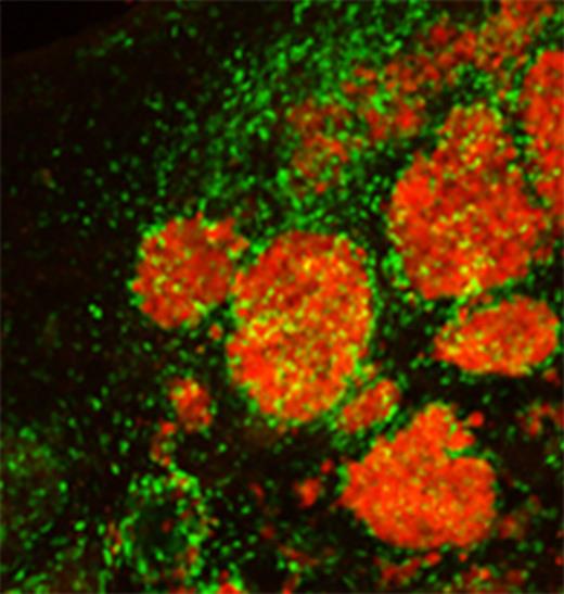 Metastatic brain tumours typically occur as multiple foci, making them difficult to treat. Bagci-Onder, Du et al. report the development of an in vivo imageable breast-to-brain metastasis mouse model, as well as an efficient stem cell-based therapeutic strategy that allows targeted destruction of tumours and eradication of therapeutic stem cells post-treatment.