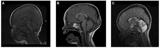 MRI of the brains of Cases 2, 3 and 4. (A and B) Cases 2 and 3 showing a normal brain MRI. (C) Case 4 brain MRI shows a small cerebellum, with increased spacing of the cerebellar folia and an enlarged fourth ventricle. This was reported to be cerebellar atrophy, rather than hypoplasia.