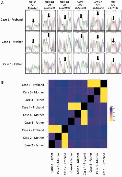 Confirmation of parentage in Cases 1–4. (A) Sequences of rare SNPs in parents and affected of Case 1 showing consistency with parentage: genes, variant and genomic location (hg19) are shown. (B) The non-reference discordance rate (NDR) over 86 000 exonic Hapmap SNPs for Cases 2, 3 and 4. Related individuals show lower discordance (yellow) than unrelated individuals (blue/purple). This analysis confirms that the probands in the study are genetically related to both parents and that parents are not genetically related to each other.