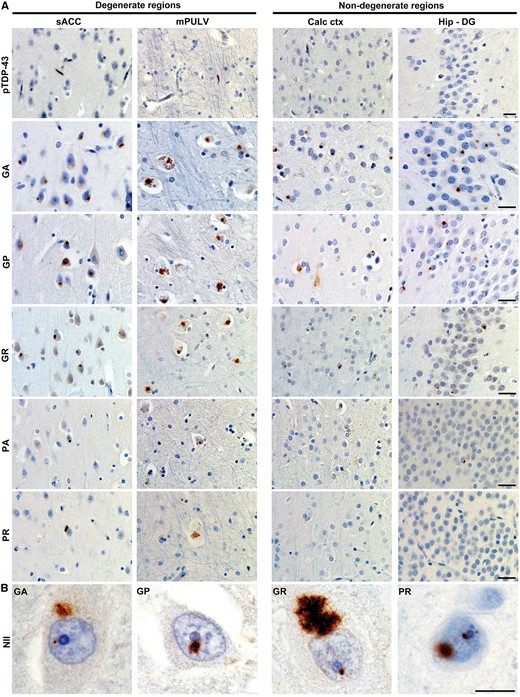 Abundant dipeptide repeat protein inclusions in the near absence of TDP-43 aggregation (Case 1). (A) Representative images show dipeptide repeat protein inclusions in degenerate and non-degenerate brain regions. pTDP-43 immunostaining showed sparse to absent TDP-43 inclusions. GA, GP and GR NCI were abundant whereas PA and PR aggregates were sparse to absent. Scale bars = 25 µm. (B) Occasional neuronal intranuclear inclusions (NII) were also observed, often adjacent to the nucleolus, for all dipeptide repeat proteins except for PA. Scale bar = 10 µm. sACC = subgenual anterior cingulate cortex; Calc ctx = calcarine cortex; Hip-DG = dentate gyrus of hippocampus.