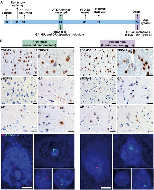 C9orf72-specific pathological inclusions precede TDP-43 aggregation. (A) Schematic shows clinical milestones (above) and microscopic neuropathological features (below) in reference to the patient’s age timeline. (B) The resected left anterior temporal lobe represents the preclinical stage and is compared to post-mortem tissue from the contralateral anterior inferior temporal lobe. In the resected left temporal lobe, TDP-43 immunostaining revealed only a single NCI and no dystrophic neurites (Fig. 5). Intriguingly, numerous neurons lacking normal nuclear TDP-43 were observed in the apparent absence of a TDP-43 inclusion (arrowhead). These findings stand in contrast to the well-developed FTLD-TDP, type B, seen at autopsy. RAN-translated GA, GP and GR inclusions, as well as sense and antisense RNA foci, were conspicuous in both surgically resected tissue and post-mortem brain. Images with RNA foci are maximum intensity projections of a z-stack image to show the approximate abundance of foci within individual nuclei. Scale bars = 25 µm for bright field and 5 µm for fluorescent images. FTLD = frontotemporal lobar degeneration; DN = dystrophic neurites; RAN = repeat associated non-ATG; MAC = Memory and Aging Center; UCSF = University of California, San Francisco; ATL = anterior temporal lobe; EMU = Epilepsy Monitoring Unit.