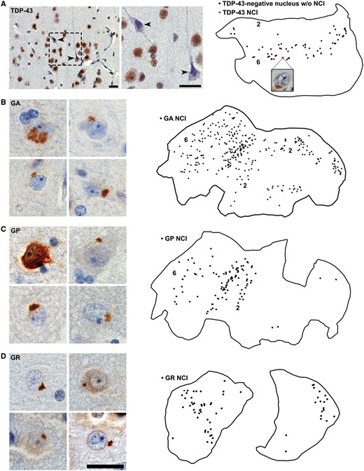 Distribution of C9orf72 expansion-associated inclusions in Case 2’s preclinically resected lateral temporal lobe. Tissues sections were traced and subjected to exhaustive mapping at 60× magnification. (A) TDP-43 immunohistochemistry revealed numerous neurons lacking nuclear staining despite the absence of an apparent TDP-43 inclusion (arrowheads in photomicrographs and black dots in map). These neurons were most abundant in deep cortical layers. Only one neuron with a TDP-43 cytoplasmic inclusion was observed (red dot and map inset). (B–D) GA, GP and GR dipeptide repeat protein NCI were abundant. Numbers 2 and 6 denote cortical layers within section tracings. Scale bar = 25 µm.