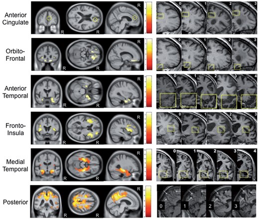 Correlation between grey matter volume and visual rating score. Voxel-based morphometry images demonstrating negative partial correlation between grey matter volume and each visual rating scale, adjusted for the other scales (Y = β AC X AC + β OF X OF + β AT X AT + β FI X FI + β MTA X MTA + β PA X PA + β Age X Age + β Gender X Gender + β TIV X TIV + β 1T X 1T + β 3T X 3T + β London X London + β Amsterdam X Amsterdam + μ + e). In all images statistical significance of correlations was corrected for multiple comparisons (family wise error rate P < 0.05). The corresponding visual rating scale reference images are displayed adjacent to each statistical parametric map. R indicates the right hemisphere.