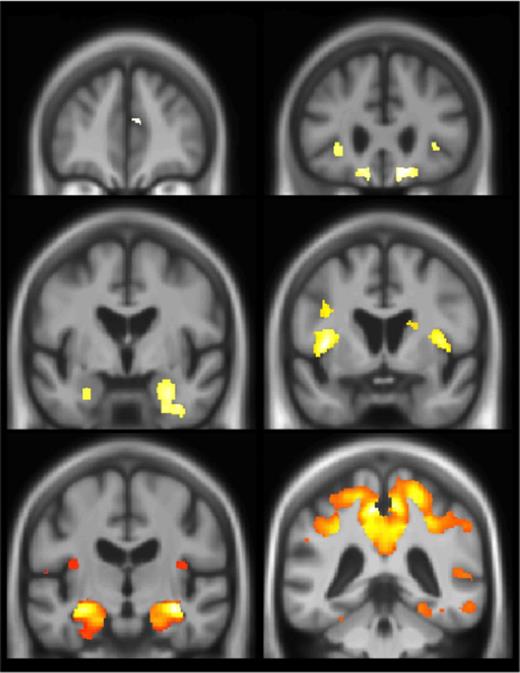 Distinguishing between the degenerative dementias during life can be challenging. Using histopathologically confirmed cases for comparison, Harper et al. evaluate six visual rating scales for use with routinely acquired structural MRI. Automated classification based on all six scales provides a practical, fast and inexpensive means of improving diagnostic certainty.