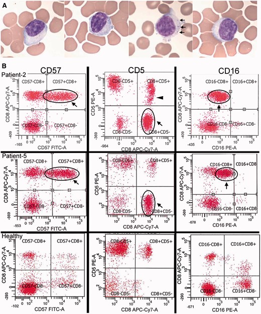 Detection of large granular lymphocytes by blood smears and flow cytometry. ( A ) Blood smears from four patients demonstrating large lymphocytes with eccentric nuclei and sometimes visible cytotoxic granules (seen in one of the patients, arrows). ( B ) Two IBM patients (Patients 2 and 5) with large CD8+ CD57+ expansions of T-LGLs that are aberrant with CD5-negative ( middle ) and CD16-dim ( right ) expression. Patient 2 additionally has a CD5-dim population (arrowhead). In comparison, healthy patient flow cytograms. With permission, Inclusion Body Myositis Foundation.