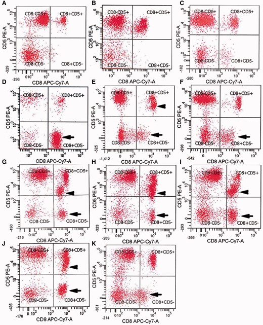 Aberrant loss of expression of CD5 by CD8+ T cells in IBM blood. ( A – C ) Normal expression of CD5 on essentially all CD8+ T cells in ( A ) healthy subject, ( B ) patient with dermomyositis, ( C ) patient with polymyositis. ( D – K ) Loss of CD5 in a subpopulation of CD8+ T cells (arrows) in patients with IBM (Table 1, Patients 5, 25, 31, 21, 14, 12, 2, 19). Some of these patients have both CD5-dim (arrowheads) and CD5− populations. x -axes: CD8; y -axes: CD5.