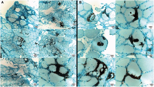IBM muscle CD57+ cell infiltration. ( A ) Dense T cell infiltrates containing CD57+ cells. ( B ) Myofibre invasion by CD57+ cells. Images from six patients shown. With permission, Inclusion Body Myositis Foundation.