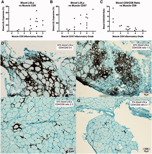 Blood LGL expansions and reduced CD4/CD8 ratios are associated with muscle CD8 and CD57 inflammatory grade. ( A – C ) Increased numbers of muscle CD8+ cells and CD57+ cells is correlated with increased numbers of CD8+ CD57+ blood LGLs and reduced CD4/CD8 ratios. ( D – G ) CD8 immunohistochemistry of muscle from four patients ( D , Patient 2; E , Patient 21; F , Patient 30, G , Patient 38) illustrates relationships between blood LGL and muscle CD8 expansions. With permission, Inclusion Body Myositis Foundation.