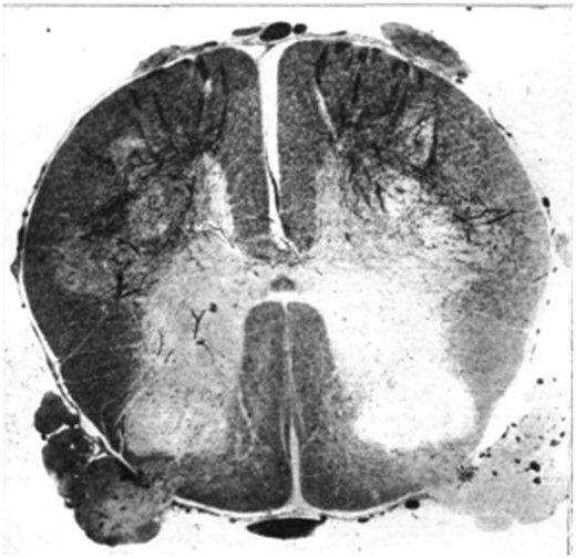 Section of spinal cord of a child who died six weeks after the onset of the disease, stained by Marchi method, showing degeneration of the efferent fibres of the anterior roots.