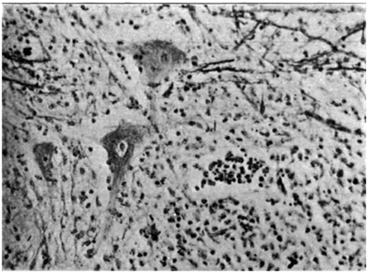 Photograph of the ganglion cells of the anterior horn showing varying degree of ‘neuronophagia’.