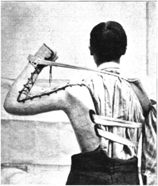 Man with poliomyelitis of the shoulder muscles of the left arm. The splint has an additional support from a strap and band around the right shoulder.