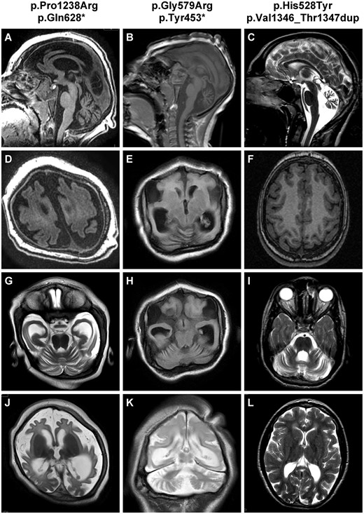 Representative brain MRI of patients with WDR81 mutations. Patients Im-MCD_606 (p.Pro1238Arg; p.Gln628*), Rdb-MIC_233 (p.Gly579Arg; p.Tyr453*) and CerID-22 (p.His528Tyr; p.Val1346_Thr1347dup) respectively aged 22 months (A, D, G and J), 4 years (B, E, H and K), and 14.5 years (C, F, I and L) at the time of MRI. Sagittal sections T1-weighted (A and B) or T2-weighted (C) show moderate (A) to severe cerebellar atrophy (C), and thin corpus callosum in all cases. Axial weighted sections show extreme gyral simplification (D and E) or milder (F), with area of absence of gyri (agyria) without thickening of cortex. At the level of the cerebellar hemispheres, cerebellar atrophy with excess of visibility of hemisphere foliation (G, H and I); T2-weighted sections also demonstrate delayed myelination at 22 months (J), hypomyelination at 9 years (K) or periventricular white matter hyperintensities (L).