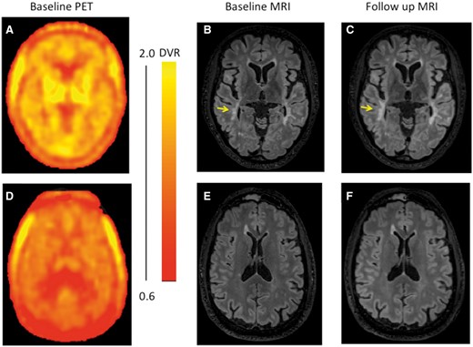 Illustrative PET and MRI images. Illustrative parametric brain PET 11C-PBR28 DVR images at baseline (A and D) from two patients with associated T2 FLAIR images at baseline (B and E) and after ∼1 year (C and F). The top panels (A–C) are from a patient (EDSS 4.0) with high average NAWM DVR (1.35) (Patient A19 in Table 1). The yellow arrowhead highlights a lesion that enlarged over the observation interval. The bottom panels (D–F) include images from a patient (EDSS 6.0) with low average NAWM DVR (0.88) for whom no enlarging T2 lesions were found between the baseline (E) and follow-up (F) MRI scans (Patient A5 in Table 1). The colour bar to the right of the PET images shows the dynamic range of DVR in the images (A and D).