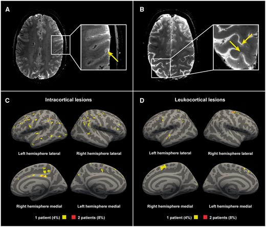 Examples of cortical lesions detected with 7 T T2*-weighted imaging. (A) A 36-year-old female multiple sclerosis subject with a disease duration of 1.8 years, EDSS score of 0; (B) A 45-year-old female multiple sclerosis subject with a disease duration of 2.9 years, an EDSS score of 3. Lesion probability maps of (C) intracortical lesions and (D) the cortical portion of leukocortical lesions in all multiple sclerosis subjects displayed on fsaverage. Yellow indicating lesions in 4% (1 of 25 subjects). Red indicating 8% (2 of 25 subjects) having overlapping lesions (maximum overlap).