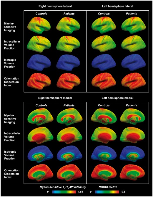 Lateral and medial views in right and left hemispheres of myelin-sensitive imaging and NODDI metrics sampled at mid-cortical depth in multiple sclerosis subjects and healthy controls and displayed on fsaverage. A trend of lower myelin-sensitive contrast in the superior frontoparietal regions was visually noted in multiple sclerosis subjects compared with controls (blue arrows). A notable topographical organization of the NODDI metrics was seen across the cortex, specifically with clear banding of the metrics in the sensorimotor cortices (purple arrows). WI = weighted imaging.