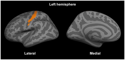 The orientation dispersion index in the primary somatosensory area in the left hemisphere was positively correlated with the expanded disability status scale scores. The significant cluster (after correction for multiple comparisons and the cortical thickness) is displayed on fsaverage.