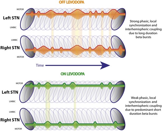 Summary schematic. Illustrates the left and right STN with a series of beta bursts during OFF and ON levodopa located in the dorso-lateral motor region (Horn et al., 2017). During OFF levodopa there are short and long duration beta bursts, while during ON levodopa shorter bursts are predominant. Long duration beta bursts lead to a stronger phasic synchronization within the STN motor region, which is related to motor impairment in Parkinson’s disease. Beta bursts co-occur between hemispheres and are phase coupled, while these overlapping periods are more common during OFF levodopa compared to during ON levodopa.
