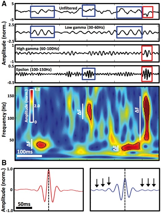 Discrete detections of gamma frequency activity showing narrow and broad frequency spans. (A) Top panel shows raw data epoch together with its band-pass filtered signals in the low gamma, high gamma and epsilon frequency ranges. Detections of GA events showing narrow and broad frequency spans are highlighted in blue and red rectangles, respectively, as outlined in the corresponding spectrogram below (Supplementary material). The bottom panel spectrogram delineates spectral boundaries of each of the four detections (black line), showing their frequency span (i.e. bandwidth) in white vertical bars (ΔF) that was used to classify them into broadband and narrowband events. (B) Average amplitude changes of 922 broadband (left, red) and 1578 narrowband (right, blue) detections with peak amplitude at frequency band 43–47 Hz aligned to the time of peak amplitude (dashed line). Detections were taken from all active occipital cortical contacts in one patient implanted with subdural electrode grid. Notice nine consistent cycles of oscillation in the 200 ms window of the narrowband detections (black arrows point to cycles extending beyond the central waveform), in contrast to the broadband detections.