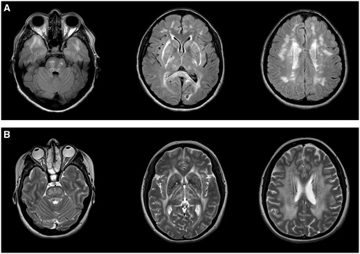 CADASIL and CARASAL imaging appearance. (A) Typical imaging appearance of CADASIL in axial FLAIR MRI images. There is symmetric subcortical high signal in the anterior temporal lobes, internal and external capsules and scattered asymmetric involvement of the periventricular cerebral white matter and pons. (B) CARASAL in T2 axial images. There was no involvement of the anterior temporal lobes (left) but there was extensive involvement of the internal and external capsules, the basal ganglia and thalami (middle) and the periventricular and deep white matter (right).