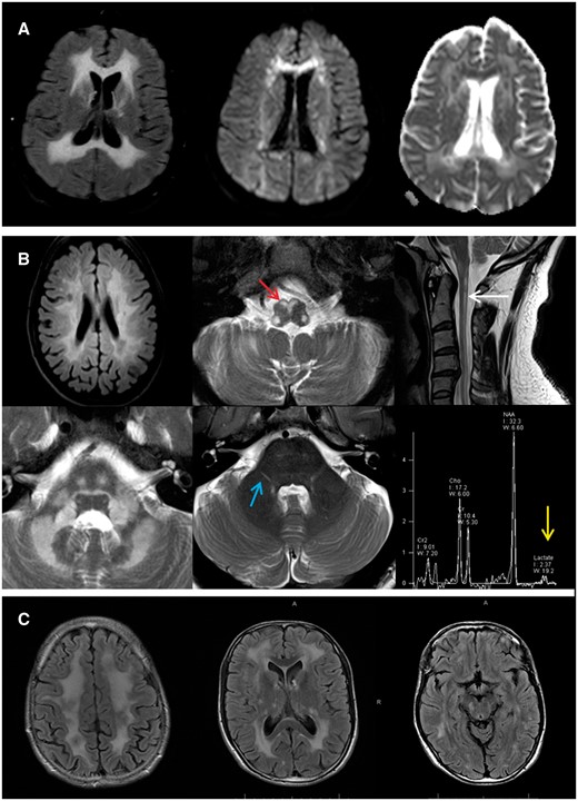 AARS2, DARS2 and RNF216 imaging appearance. (A) Typical imaging appearance of AARS2-related leukoencephalopathy. There is an extensive, symmetric white matter abnormality in the frontal, parietal and occipital lobes on the FLAIR imaging (left), with evidence of restricted diffusion on diffusion weighted imaging (middle) and apparent diffusion coefficient (right). (B) DARS2-related leukoencephalopathy. Axial FLAIR MRI image (top left) discloses bilateral deep and periventricular cerebral white matter involvement. Axial and sagittal T2-weighted MRI images show hyperintensity in the medullary pyramids (red arrows), the posterior columns of the spinal cord (white arrow), the deep white matter of the cerebellum and along the intraparenchymal tracts of the trigeminal nerves bilaterally (blue arrows), in addition to a lactate peak on short echo time magnetic resonance spectroscopy (yellow arrow). (C) RNF216-related leukoencephalopathy with diffuse supratentorial white matter signal abnormality appreciated in axial FLAIR MRI images.