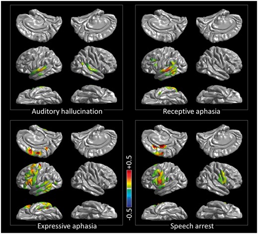 3D probabilistic mapping of cortical function based on the results of cortical stimulation in the older group. Auditory hallucination: perception of various pitches of sounds or alteration of the neuropsychologist’s voice’s pitch. Speech arrest: inability to initiate and continue vocalization not directly explained by the effect of forced jerking of tongue or lip. Expressive aphasia: dysnomia or inability to provide a relevant answer during a 5-s stimulation although the neuropsychologist (R.R.) confirmed that a given question was understood and the capability of vocalization was maintained. Receptive aphasia: inability to understand a question though being aware that a question was given by the neuropsychologist. To differentiate the nature of aphasia, the neuropsychologist asked each patient the reason, in case he/she failed to verbalize a relevant answer during stimulation. The locations of stimulation-induced sensory/motor symptoms are presented in Supplementary Fig. 2. The maps derived from the younger group are provided in Supplementary Fig. 3.
