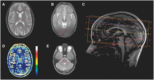 Location of the investigated regions of interest. Regions of interest are marked with red lines. (A) T2-weighted image showing regions of interest on the left and right side of regions of the anterior, middle and posterior cerebral circulation. (B) T2-weighted image showing regions of interest in the right visual cortex. (C) Sagittal T1-weighted image showing location of axial slices. (D) Cerebral perfusion corresponding to (same slice as) A. The colour bar gives the perfusion values from 0 (bottom) to 120 (top) ml/100 g/min. (E) T2-weighted image showing region of interest in the right side of the brainstem.