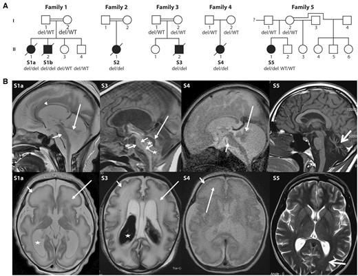 Pedigrees and brain MRI from five unrelated families with cerebellar disorders. (A) Pedigrees and ATAD3 genotypes for available members of Families 1–5. (B) Brain MRI of Subjects S1a, S3, S4 and S5. Top row: Sagittal images of Subjects S1a, S3 and S4 in the neonatal period and Subject S5 at 22 years of age. The neonates have severe brainstem and cerebellar hypoplasia with flat pons (short arrows) and tiny cerebellar vermis (long arrows). There is increase of the tegmento-vermian angle and ex vacuo enlargement of the posterior fossa CSF spaces. Arrowheads indicate the thin corpus callosum. Stars in Subject S3 show isointense blood products within and below the fourth ventricle. Subject S5 presents with severe hypoplasia/atrophy of the cerebellar vermis (thick arrow) with ex vacuo enlargement of the fourth ventricle; brainstem and normal corpus callosum are normal. Bottom row: Axial T2-weighted images show simplified sulcation and gyration more marked frontally (short arrow) and diffuse white matter T2 signal abnormality (long arrow) in Subjects S1a and S4. Similar but less severe changes are seen in Subject S3 with shallow simplified sulcation. Both subjects had a thin cortical ribbon, decreased white matter volumes with marked T2 hyperintensity, ex vacuo ventriculomegaly (stars) and prominence of the extra-axial CSF spaces in keeping with brain atrophy. Hypointense material within the lateral ventricles of Subject S3 is haemorrhage. Subject S5 has normal ventricles and subtle ‘frosted glass’ aspect of the posterior periventricular white matter (thick arrow). del = ATAD3 deletion; WT = wild-type.