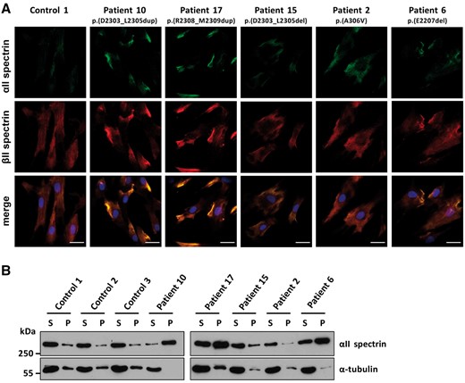 Spectrin aggregate formation in fibroblast cells of three patients with an in-frame deletion/duplication in SPTAN1. (A) Primary fibroblasts of Patients 2, 6, 10, 15 and 17 and a control individual were co-stained by mouse anti-αII spectrin and rabbit anti-βII spectrin antibodies followed by anti-mouse Alexa Fluor® 488 (green) and anti-rabbit Alexa Fluor® 546 (red) conjugated secondary antibodies, respectively, and embedded in mounting solution with DAPI (blue). Camera settings were the same for all images shown, and images were not further processed (see ‘Material and methods’ section). Representative images are shown. Scale bars = 20 µm. (B) Fibroblast cells of Patients 2, 6, 10, 15, and 17 and three control individuals were subjected to Triton™ X extraction. Supernatant (S) and pellet (P) were analysed by SDS-PAGE and immunodetection using antibodies against αII spectrin and α-tubulin as a control. Representative blots of three independent experiments are shown.