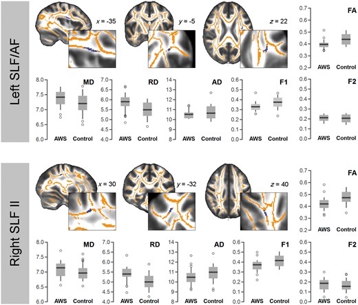 Diffusion properties of the three regions with a reduced fractional anisotropy in adults who stutter, determined by whole brain TBSS. AD = axial diffusivity; AF = arcuate fasciculus; F1 = major fibre direction; F2 = secondary fibre direction; FA = fractional anisotropy; MD = mean diffusivity; RD = radial diffusivity.