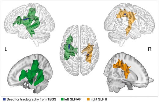 TBSS-based tractography indicate involved fibre tracts. The left tract connects the IFG with postcentral, superior parietal, and superior and middle temporal regions. On the right, precentral regions are connected to postcentral and inferior parietal regions (yellow).