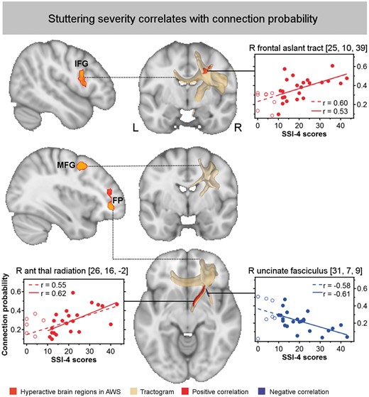 Probabilistic fibre tracking seeding in right frontal regions with increased blood oxygen level-dependent activity in adults who stutter. The connection probability was correlated with stuttering severity. Correlation coefficients are given for all adults who stutter in the upper line (n = 31, dotted line) and for those with SSI-4 > 10 in the lower line (n = 23, solid line). Positive correlations are displayed in red, negative correlation in blue, cluster-size corrected, P < 0.005, α < 0.01, two-sided.