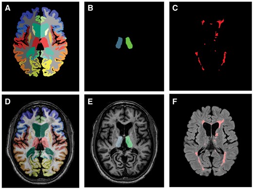 Representation of the different methods used for brain and lesion segmentation. (A) Whole brain segmentation was performed using MACRUISE (Multi-Atlas CRUISE). (B) MACRUISE segmentation overlapping the counterpart MPRAGE image. (C) Random Forest Thalamus Segmentation (RAFTS) algorithm was used for DTI-based thalamic segmentation (nuclear thalamus). (D) Overlapping of an MPRAGE image and the corresponding RAFTS thalamus segmentation. (E) S3DL was applied to Lesion-TOADS used for specific lesion segmentation. (F) FLAIR image with the corresponding lesion segmentation results overlying.