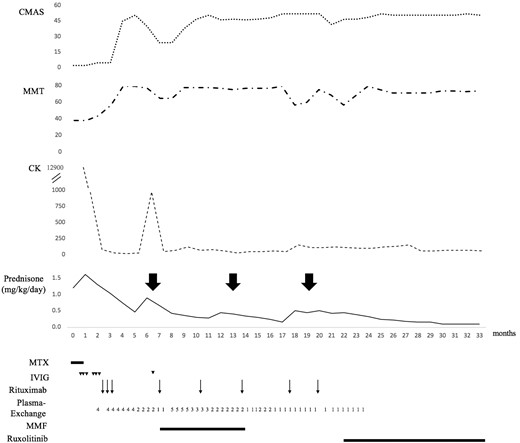 Disease course and treatment regimen. Initially, IVIG was administered on three consecutive days, 2 weeks apart. Arrowheads represent the time points of IVIG dosing (2 g/day). Rituximab was given at a dose of 375 mg/m2/week over three consecutive weeks, and then every 3 to 4 months (arrows). Plasma exchanges were initially performed four times per week, then gradually tapered to once a week and discontinued. They were restarted following a disease flare 7 months after diagnosis. The numbers represent the frequency of plasma exchanges per week. The large bold arrows indicate disease flares. CK = creatine kinase; CMAS = childhood myositis assessment scale; IVIG = intravenous immune globulins; MMF = mycophenolate mofetil; MMT = manual muscle testing; MTX = methotrexate.